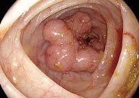 Hereditary non-polypous colorectal carcinoma