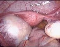 Ovarian teratoma