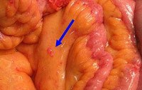 Tumors of the peritoneum