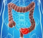 Recurrence of colon cancer