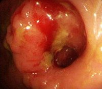 Recurrence of colon cancer