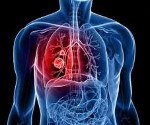 Recurrence of lung cancer
