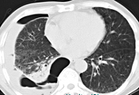 Recurrence of lung cancer