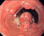 Recurrence of stomach cancer
