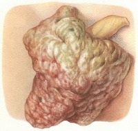Tumors of the scrotum