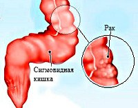 Sigmoid colon cancer