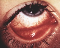Ocular manifestations of HIV