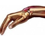 МКБ 10: Щелкающий палец (стенозирующий лигаментит)
