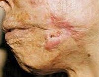 C44.9 Злокачественные новообразования кожи неуточненной области