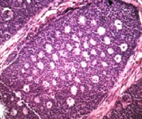 Гранулезоклеточная опухоль яичника