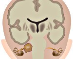 Невринома (шваннома) слухового нерва - симптомы и лечение, код по МКБ-10