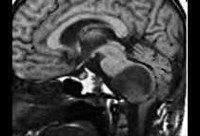C71.7 Злокачественные новообразования ствола мозга