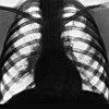 Рентгенография органов грудной полости