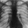 Lung radiography