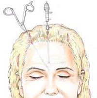 Endoscopic forehead and eyebrow lift