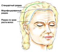 Open coronary forehead and eyebrow lift