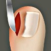 Ingrown toenail removal