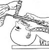 Removal of a foreign body from the pharynx