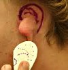 Reconstruction of the auricle
