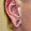 Correction of the earlobe