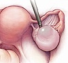 Removal of ovarian cyst