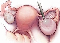 Removal of ovarian cyst