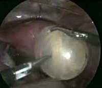 Removal of a paraovarial cyst