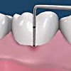 Therapeutic periodontics