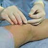Операции при патологии кожи и ее придатков