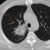 CT of the lungs
