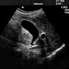 Ultrasound of the abdominal cavity