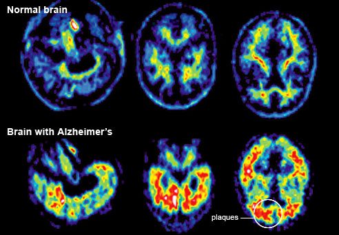 Поражение головного мозг при болезни Альцгеймера