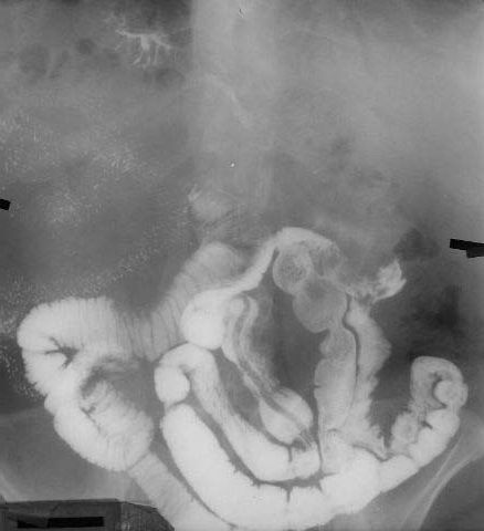 Рентгенообследование органов брюшной полости при аскаридозе