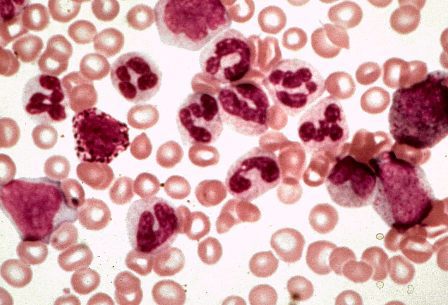 Картина крови при болезни Аддисона-Бирмера