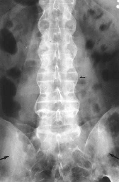 Рентгенограмма позвоночного столба при болезни Бехтерева