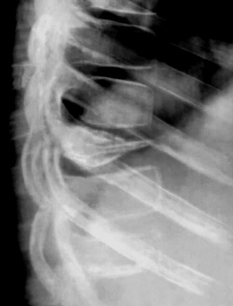 Асептический некроз тел позвонков при болезни Кальве (рентгенография позвоночника)
