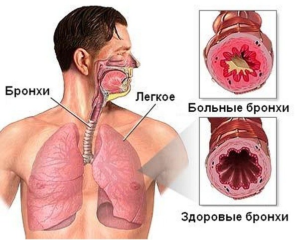 Морфологические изменения бронхов при бронхиальной астме