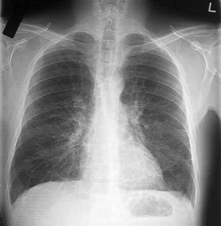 Рентгенограмма органов грудной клетки при бронхите