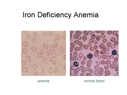 Картина крови при железодефицитной анемии (слева)