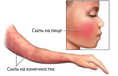Симптомы инфекционной эритемы (пятой болезни)