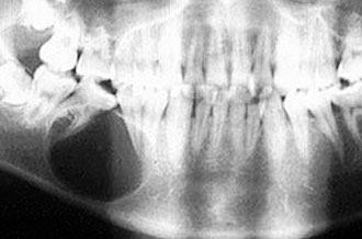 Киста челюсти (рентгенограмма)