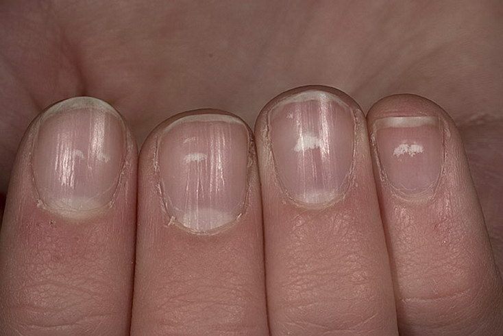 Почему появляются белые пятна на ногтях? Ответил врач. Спорт-Экспресс