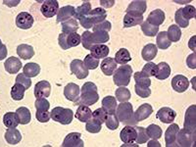 Мазок крови при малярии
