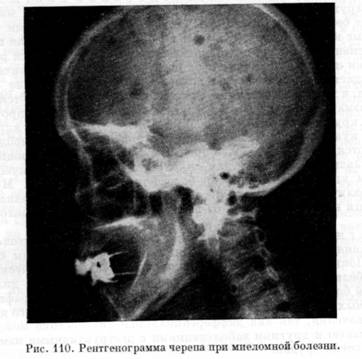 Рентгенограмма черепа при миеломе