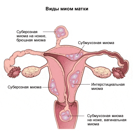 Различные локализации миомы матки