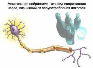Неврит срединного нерва мкб 10 код