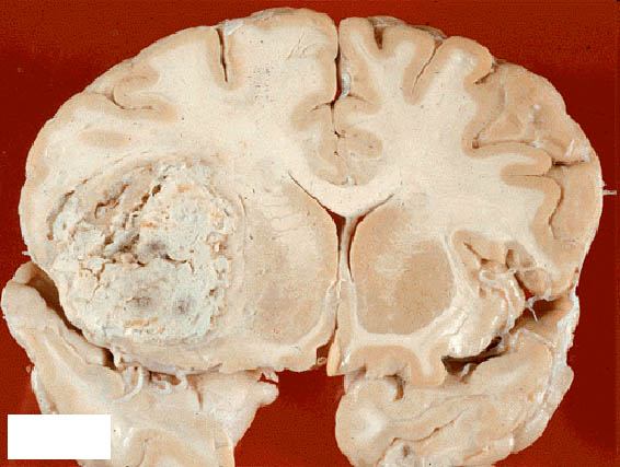 Опухоль мозга (макропрепарат)