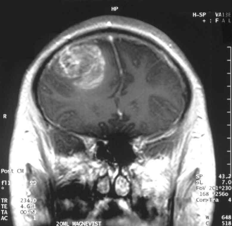 Новообразование головного мозга (МРТ)