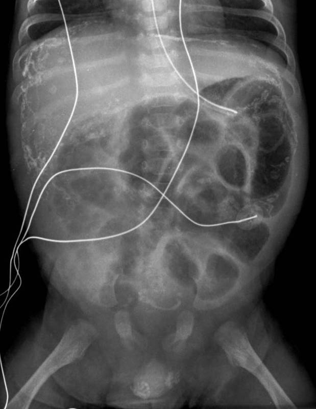 Рентгенограмма органов брюшной полости при перитоните (видны раздутые петли кишечника)
