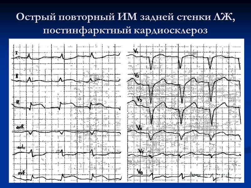 Острый повторный инфаркт миокарда задней стенки левого желудочка, постинфарктный кардиосклероз